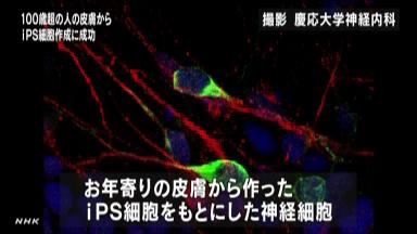 アルツハイマー患者、誘発物質が長寿者の２倍