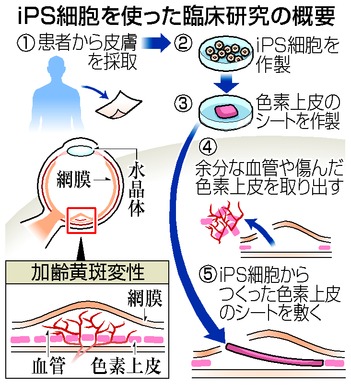 ｉＰＳ臨床研究を申請 理研、目の加齢黄斑変性６人に