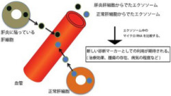 肝炎の進行度、血液だけで判断可能 大阪市大が新手法