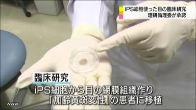 ｉＰＳ網膜再生臨床研究、承認…理研倫理委