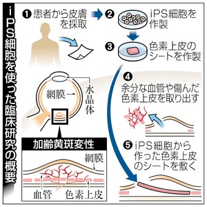 ｉＰＳ初の臨床申請 理研 １４年度網膜再生移植