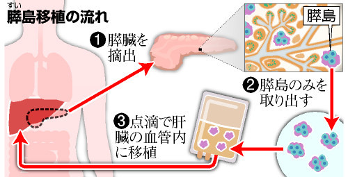 膵島だけ体内に戻す手術成功 阪大、自家移植は国内初