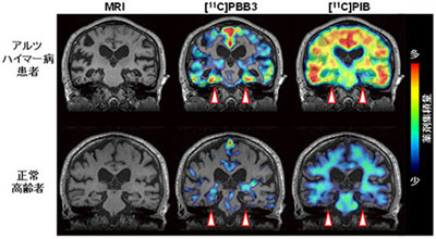 認知症初期も的確診断＝脳の異常たんぱく蓄積を画像化－ＰＥＴで初成功・放医研