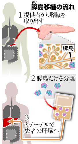 国内初の脳死膵島移植 糖尿病患者に…京大病院