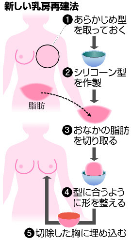 がん患者の乳房再建、きれいに早く 切除前に型取り