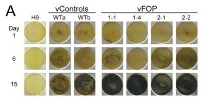 骨の難病をｉＰＳで再現…京大、治療薬開発へ道