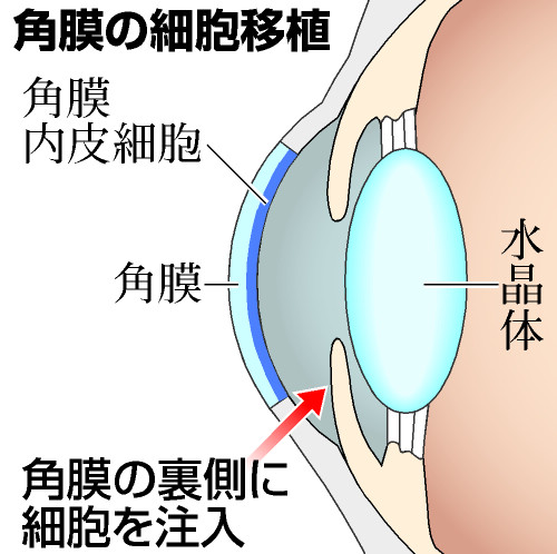 角膜細胞、体外で増やして移植 世界初、３人の視力回復