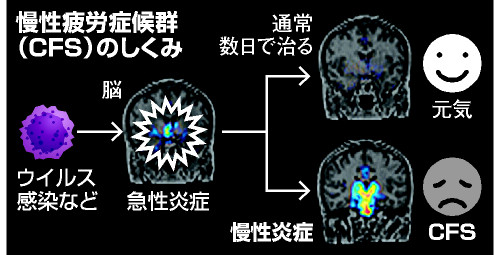 慢性疲労症候群、脳の炎症が関与 理研など解明