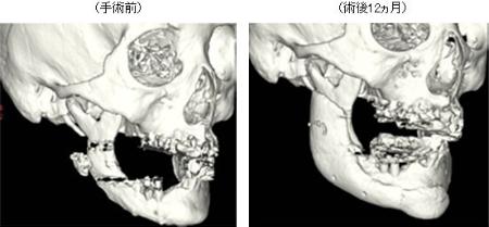 ３Ｄプリンターで人工骨を作製ＮＥＤＯなど開発、薬事承認申