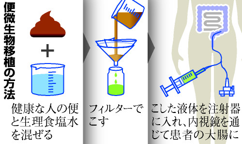 腸の難病、健康な人の便で治療？ 慶大病院が臨床試験