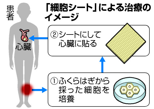 大阪大病院:心臓に自分の細胞移植 １１歳女児退院へ