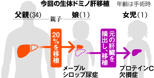 小児へ生体ドミノ肝移植、国内初の成功