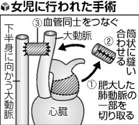 心臓病九つの新生児、「自己血管移植」初の成功 2014年08月28日 16時54分