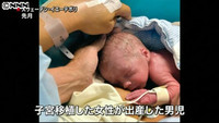 世界初 子宮移植の女性が出産