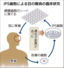 ｉＰＳ移植２例目見送り 理研など、複数の遺伝子変異