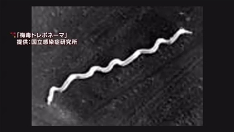 梅毒患者２千人超 若い女性で増加