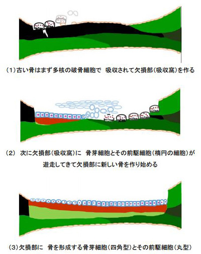 骨粗しょう症防ぐ遺伝子 東京医歯大が１つ特定