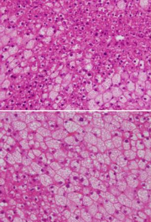 妊婦減量で子供が脂肪肝に 異常たんぱく質で炎症