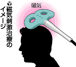 磁気で脳刺激、身体の痛み緩和…阪大など治験 2015年12月26日 12時05分