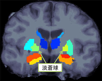 阪大など、統合失調症患者の脳で左右の体積がアンバランスな部位を発見