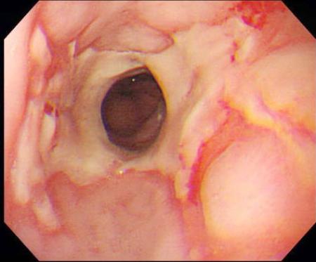 「胸焼け」に禁煙治療有効＝胃液逆流が改善－大阪市立大