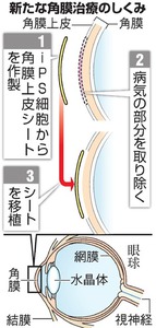 ｉＰＳから角膜細胞 ２年以内に臨床応用へ 阪大など