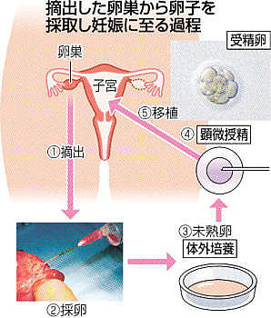 摘出卵巣からの卵子で妊娠 - 腫瘍治療と両立、信州大